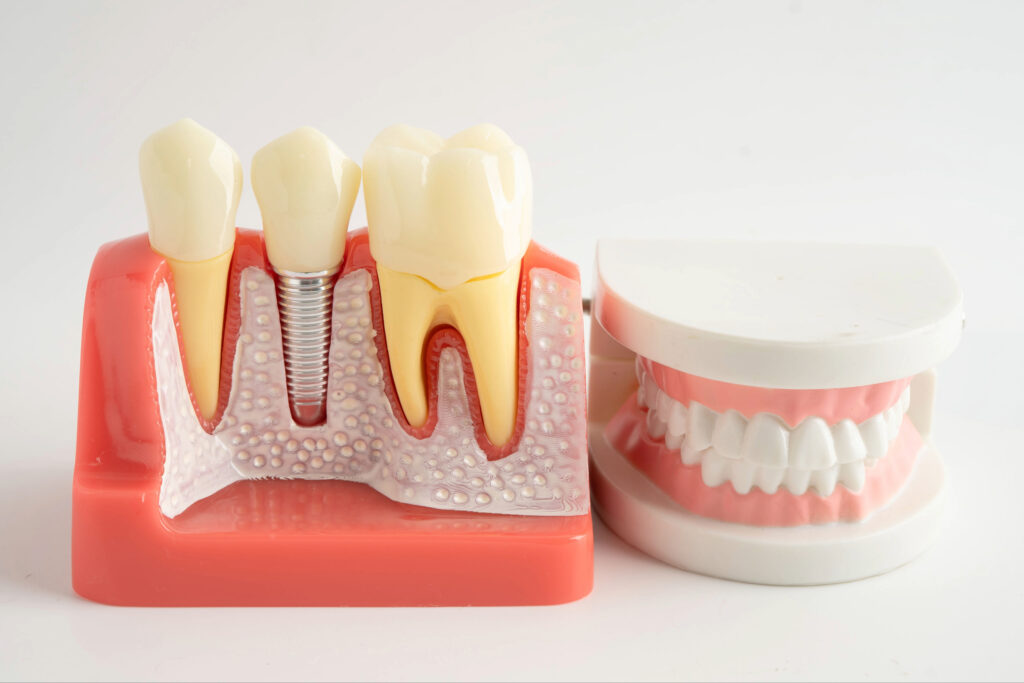 ankeny dental implants