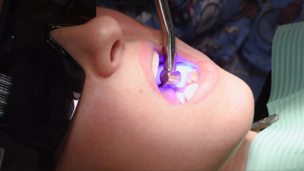 ankeny dental fillings