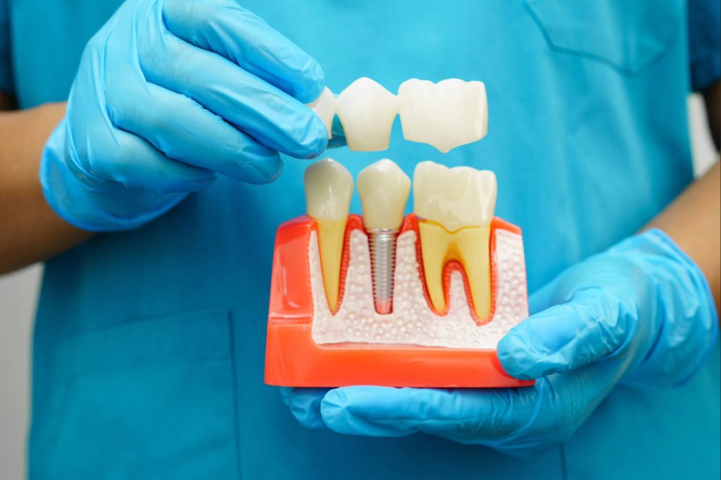 ankeny dental implants