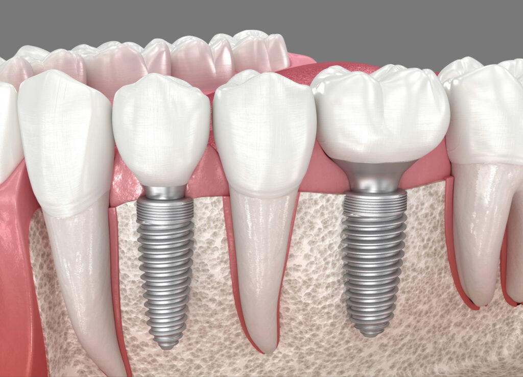 ankeny dental implants